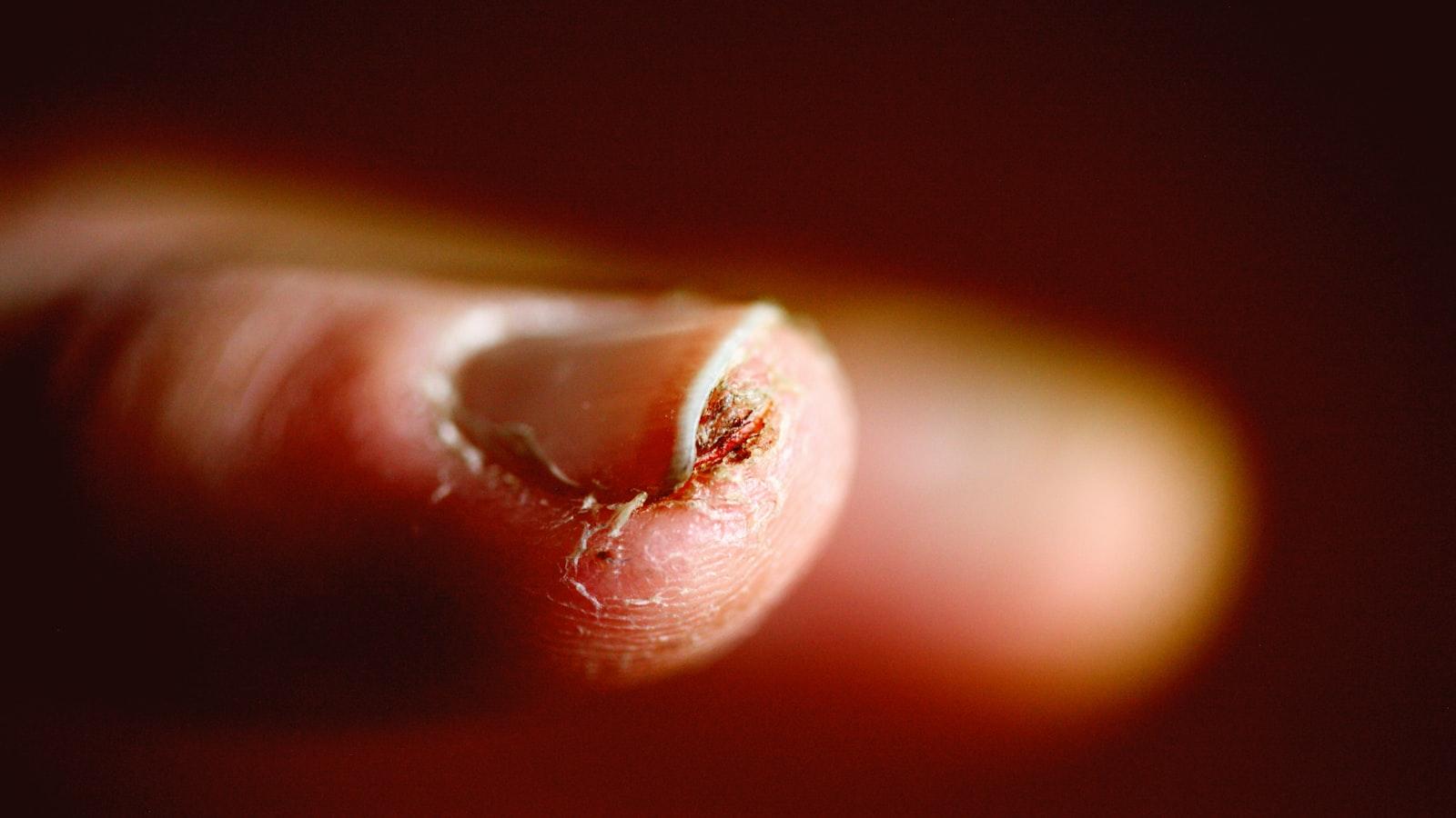 brittle nails before eating — Why Are Your Nails More Brittle Before You Eat?