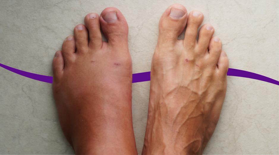 swelling during menopause — Swelling During Menopause: What It Means and What Helps