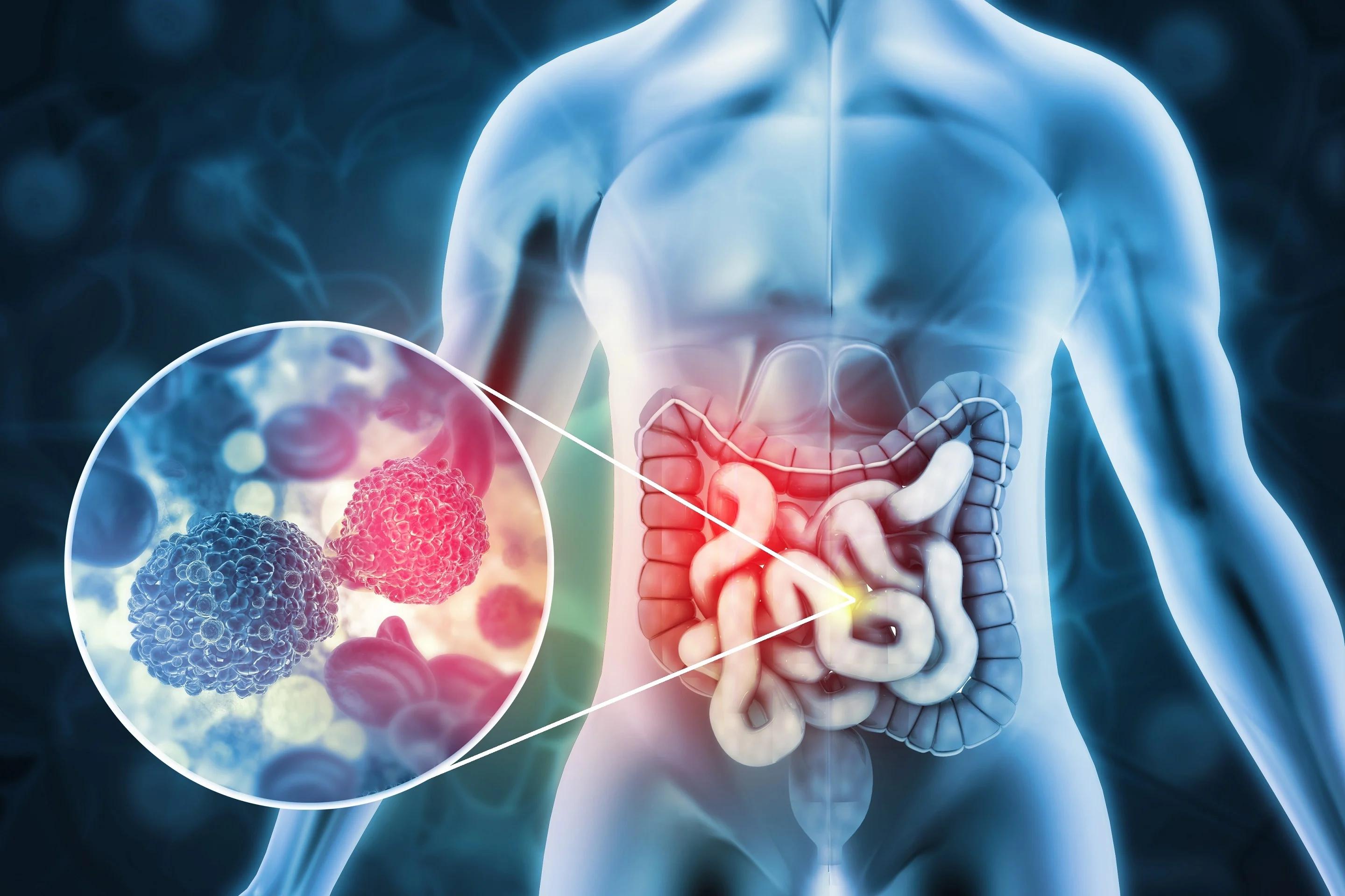 symptoms of bowel cancer in a woman — Symptoms of Bowel Cancer in a Woman: What to Watch For